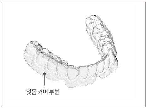 투명교정회사 투명교정종류 투명교정장치 (2) 나노라이너 관련 이미지 6
