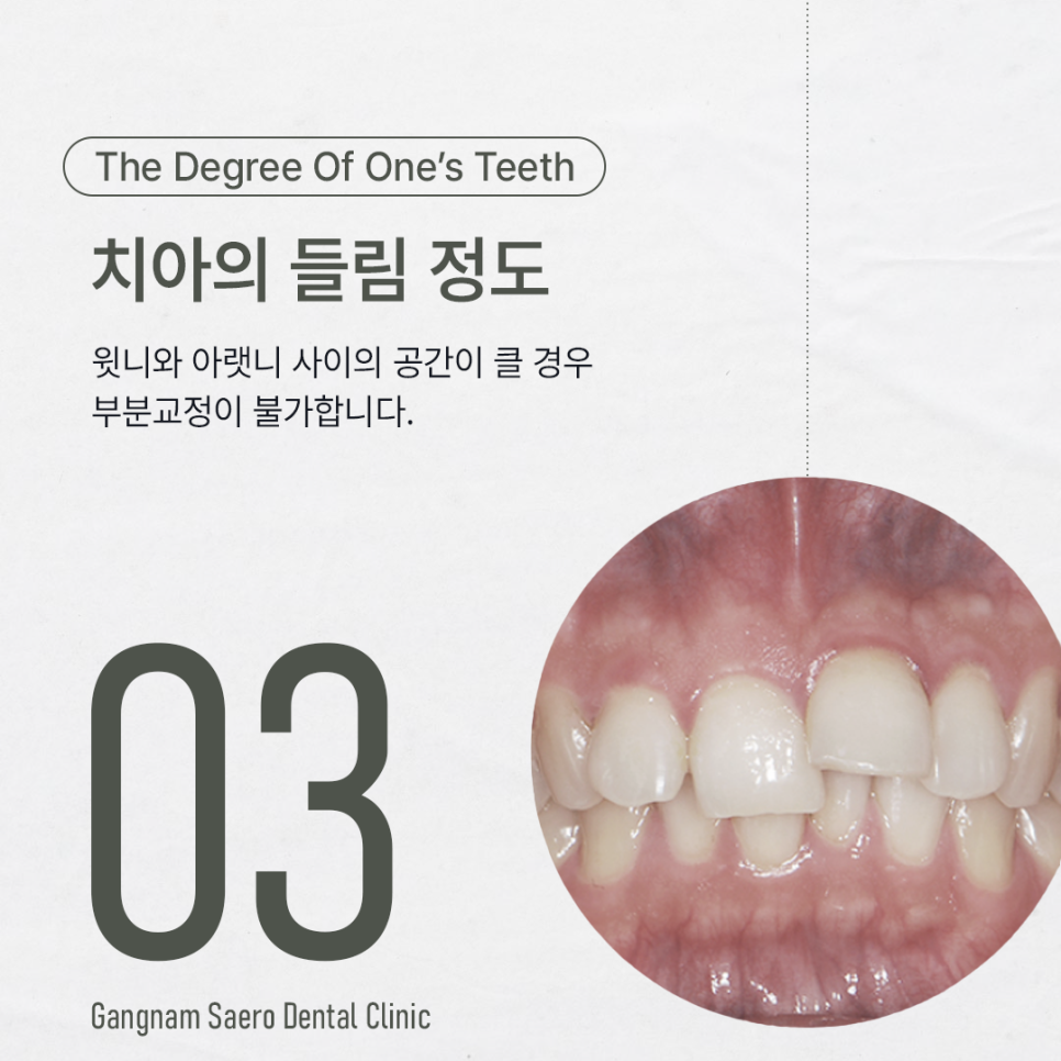 앞니만 교정하고 싶다면 부분만 교정하는 (앞니교정) 관련 이미지 4