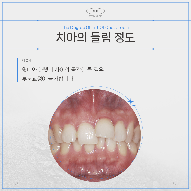 LPA MTA 부분교정 (앞니만 교정하고 싶을 땐 전체교정 대신 부분교정) [ 강남새로치과 ] 관련 이미지 5
