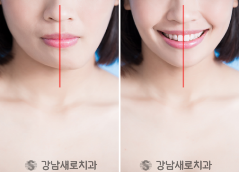 송곳니덧니교정을 발치 문제 없이 진행할 수 있다면? 관련 이미지 8