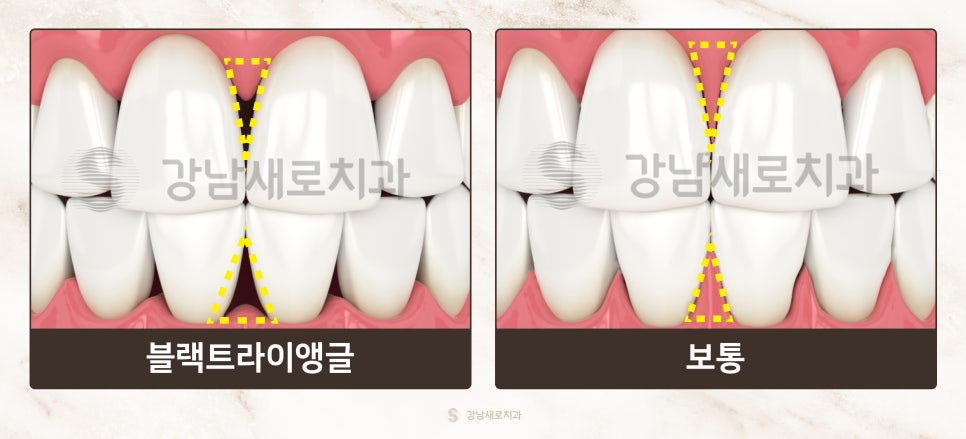 교정 부작용 총정리 [ 교정 부작용 예방법 ] [ 강남새로치과 ] 관련 이미지 1