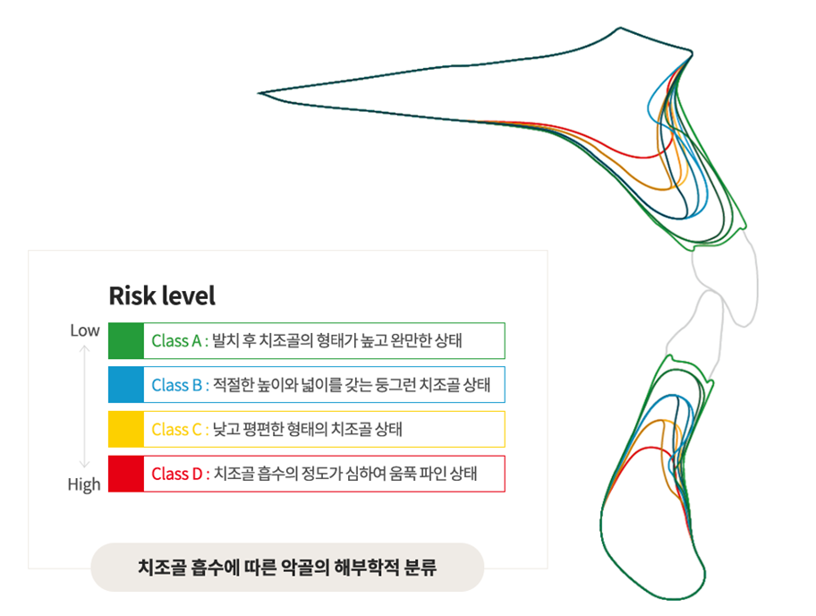 임플란트 성공률 수술 전 살펴봐야할 것 (임플란트주의사항) 관련 이미지 2
