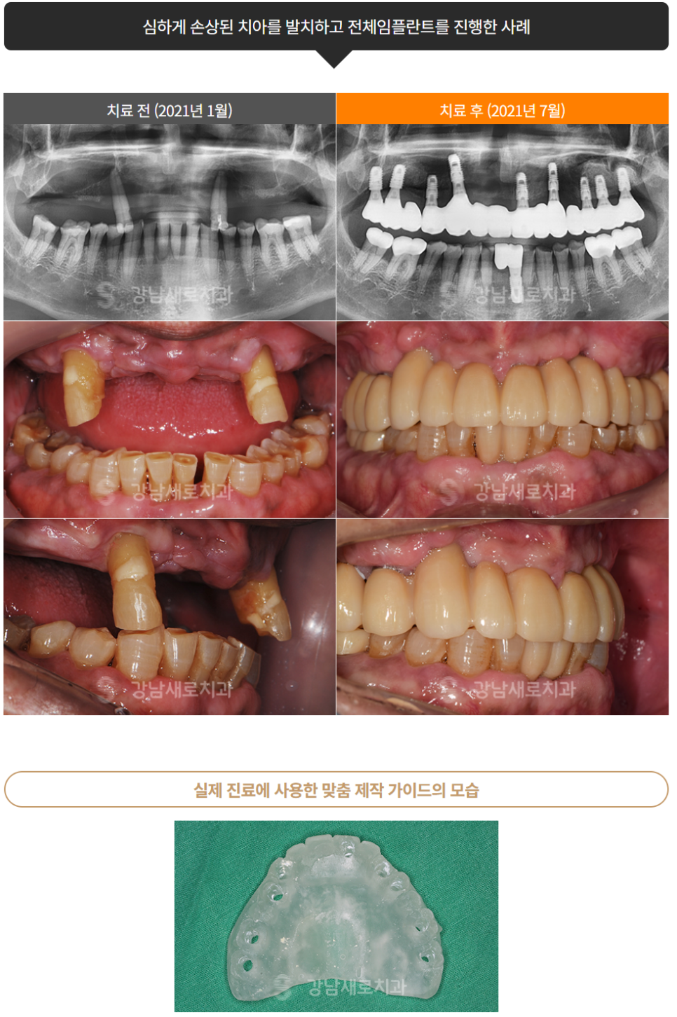 부작용 줄이는 임플란트 [ 네비게이션 임플란트 ] [ 강남새로치과 ] 관련 이미지 10