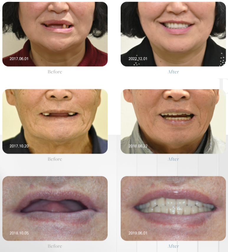 치아가 얼마 안 남은 65세이상임플란트 (전체임플란트후기) 관련 이미지 2