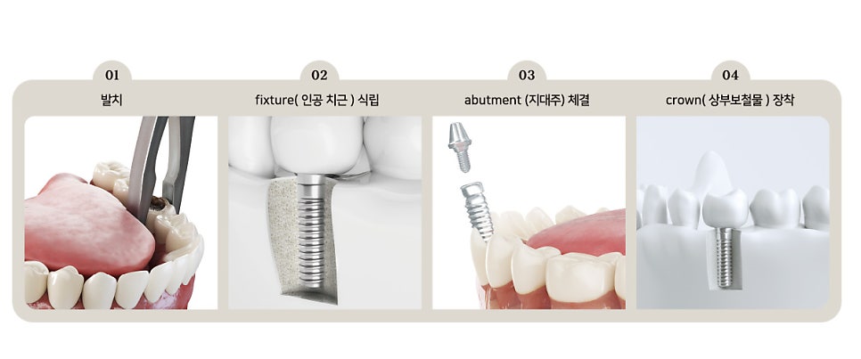 임플란트 수술 전 확인 사항 [ 병원 선택 기준 / 과잉진료 피하는 방법 ] [ 강남새로치과 ] 관련 이미지 1