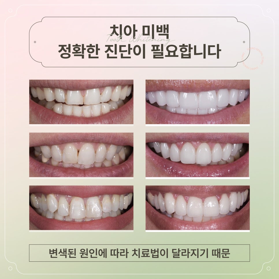 누런 이 하얗게 만들기 (원인별 치아 미백 방법) [ 강남새로치과 ] 관련 이미지 7