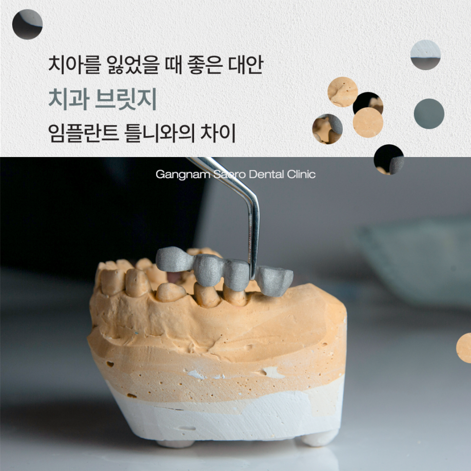 치아를 잃었을 때 치료 방법 (치과 브릿지) 관련 이미지 1