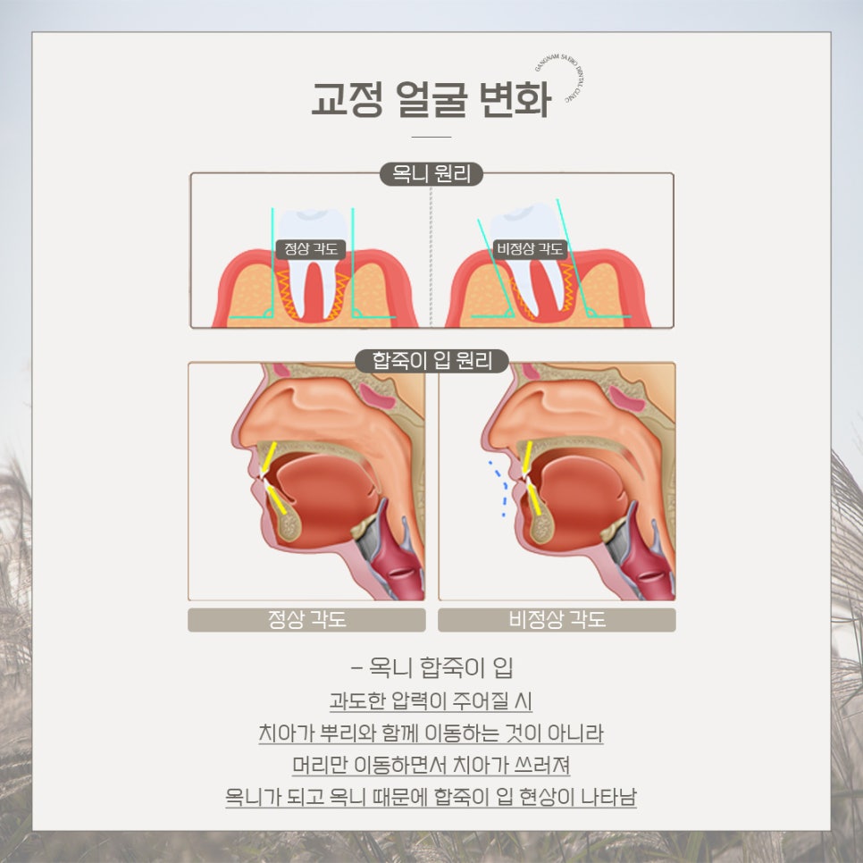 연예인 교정 후 얼굴 변화? (교정얼굴변화) 관련 이미지 3