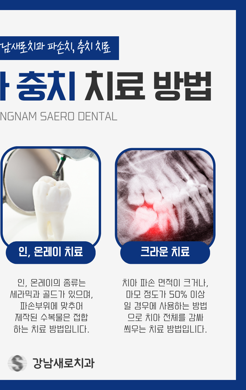 강남역 충치치료, 치아의 문제를 개선하는 과정? 관련 이미지 4