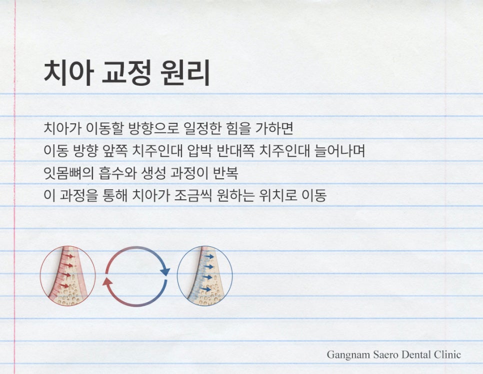 치아교정 많이 아픈가요? 통증 이유와 줄이는 방법 (치아교정통증) 관련 이미지 2