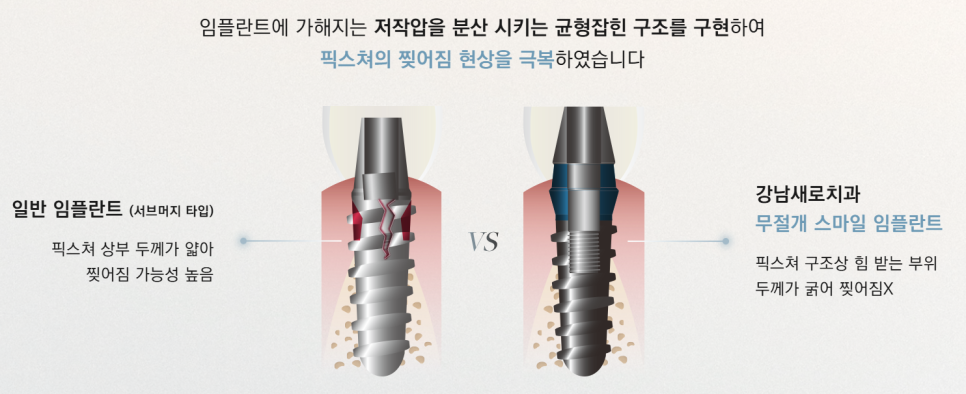 임플란트부작용 보철 (크라운, 지대주, 픽스쳐) 예방 및 대처 방법 관련 이미지 8