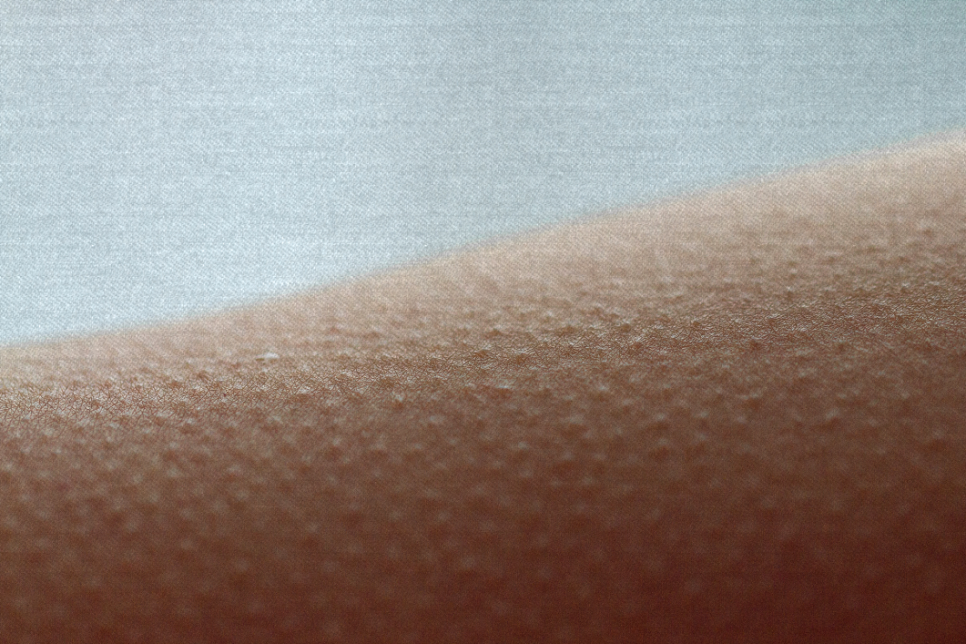 강남모공각화증 어떤 이유로 발생할까요? 관련 이미지 1