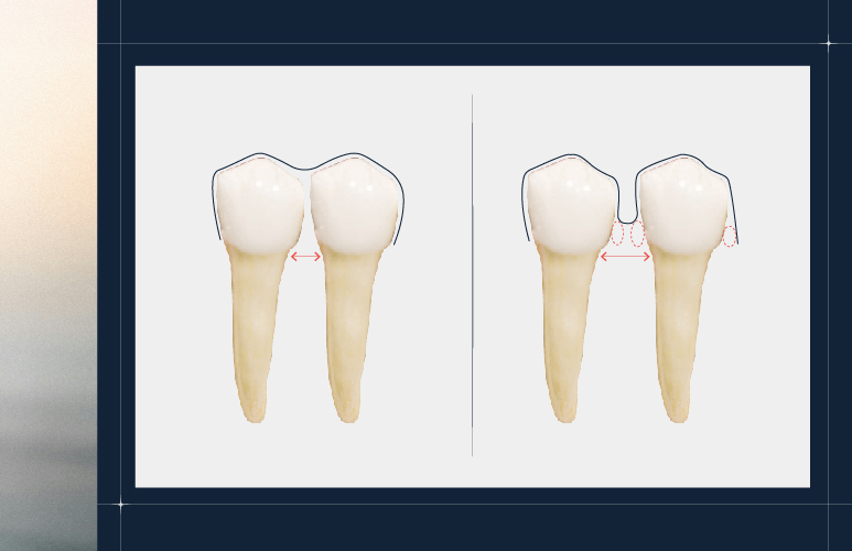 양심치과가 말해주는 투명교정 한계점 [ 강남새로치과 ] 관련 이미지 4