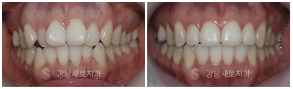 4개월만에 끝나는 부분교정 (급속교정후기) 관련 이미지 2
