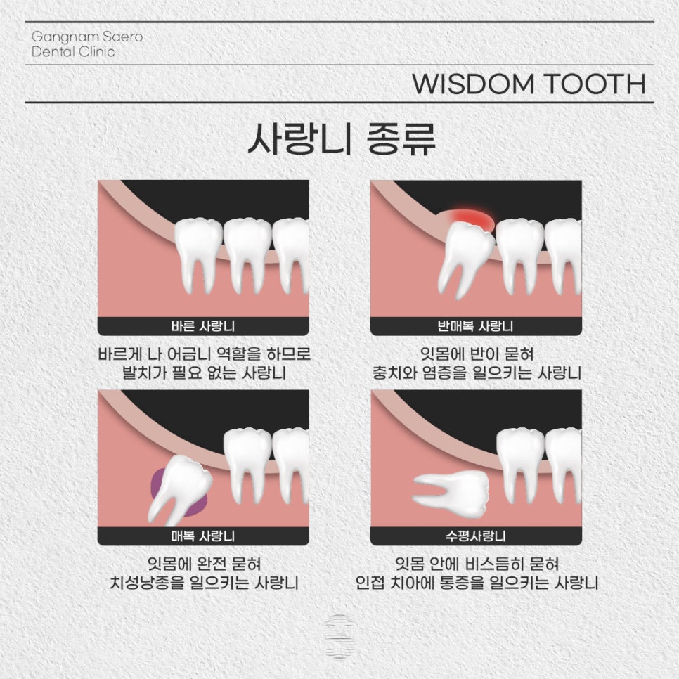 강남역근처치과 사랑니부작용 (사랑니발치) 관련 이미지 2