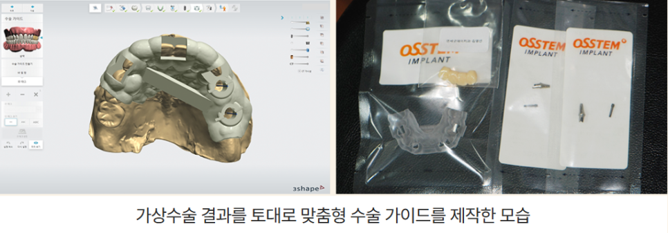 전체임플란트 부작용 최소화하려면 (성공률 높은 임플란트) 관련 이미지 8