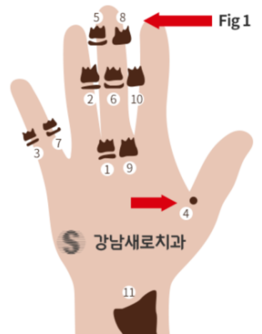 유아 주걱턱교정, 올바른 뼈 성장을 위한 방법 관련 이미지 11