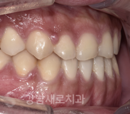 양악전 교정과 양악후 교정, 진행 방법의 차이를 알아보자. 관련 이미지 10