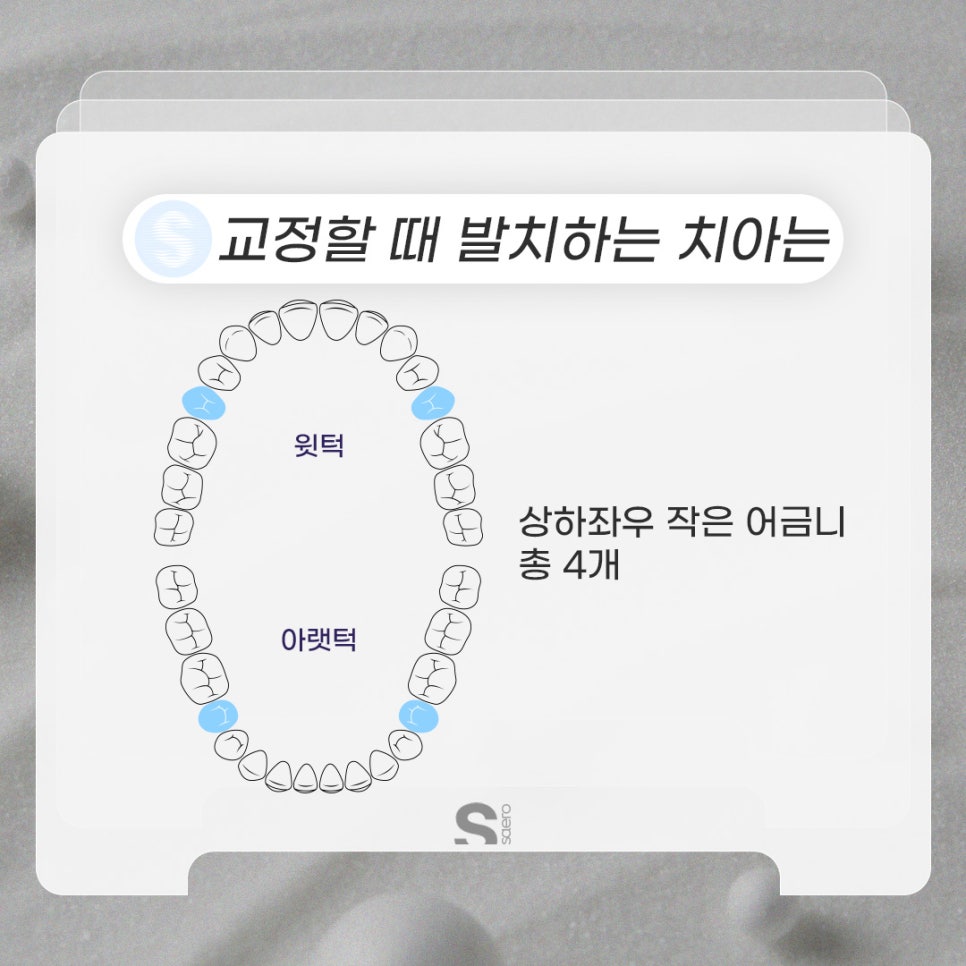 치아교정할 때 발치해야 하는 이유 (비발치중심 치아교정) 관련 이미지 3