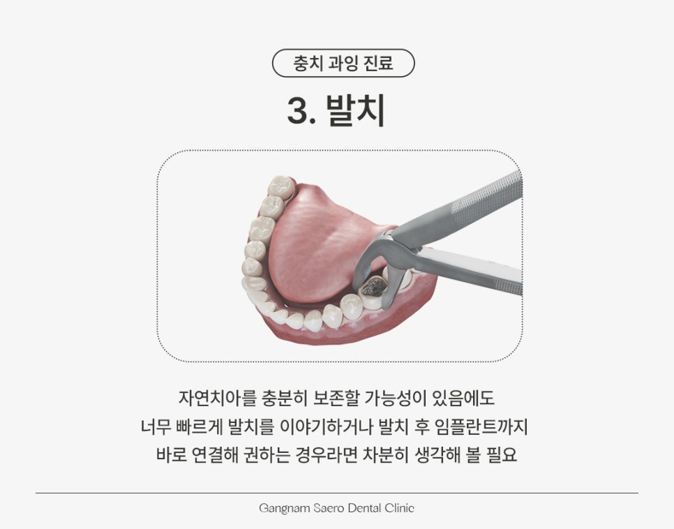 Essential Checks to Know Before Cavity Treatment (Overtreatment of Cavities) image 4