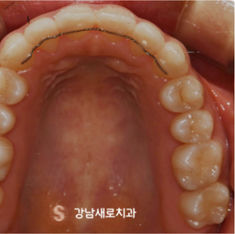 비발치교정 치료, 발치 없이 진행하는 과정 관련 이미지 7