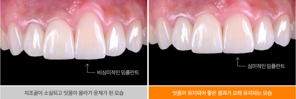 전체임플란트 부작용 최소화하려면 (성공률 높은 임플란트) 관련 이미지 10