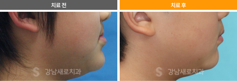 어린이주걱턱교정, 성장기전 빠른 시일내에 진행해야 하는 이유? 관련 이미지 2