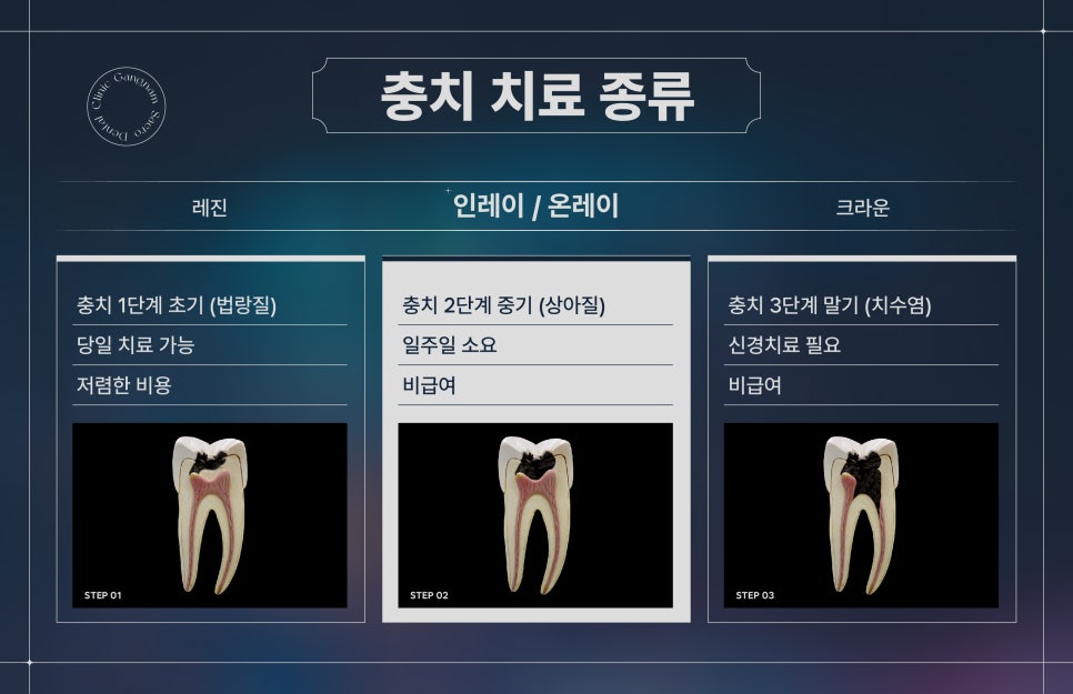 충치치료방법 레진, 인레이/온레이, 크라운 차이 (충치치료비용) 관련 이미지 4