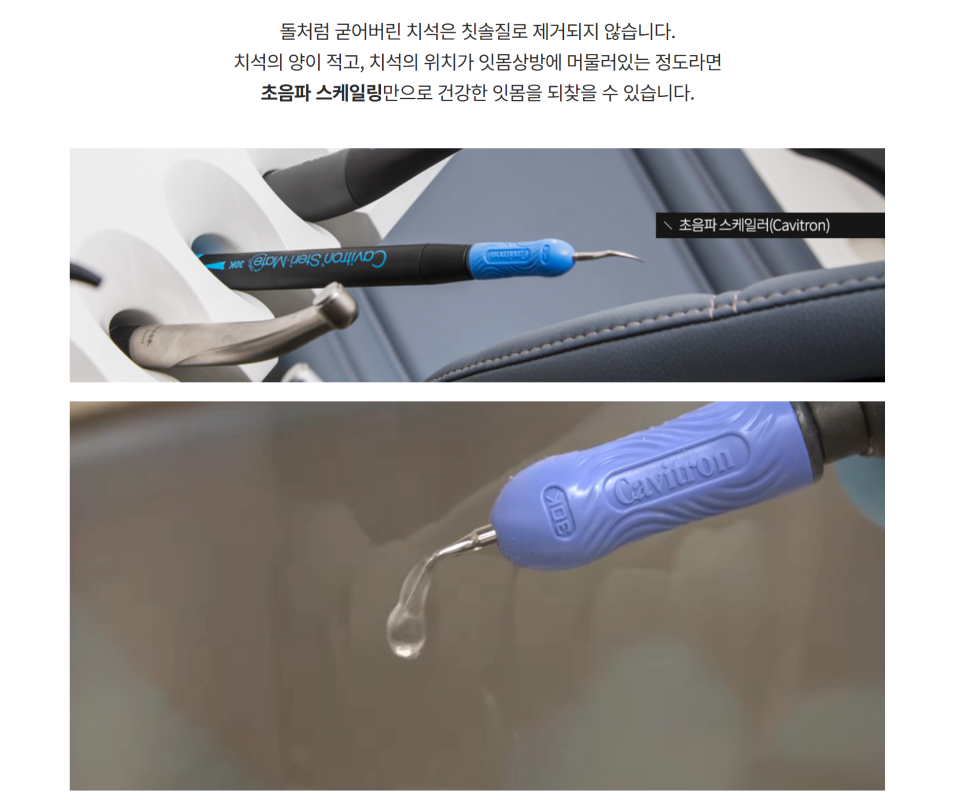 스케일링 왜 받아야 하나요? 통증이 무섭다면 무통으로! 관련 이미지 3