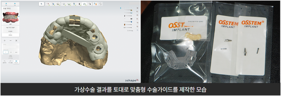 부작용 줄이는 임플란트 [ 네비게이션 임플란트 ] [ 강남새로치과 ] 관련 이미지 6