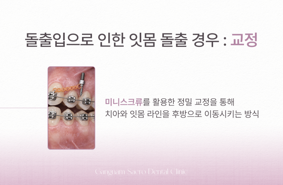 Treatment Methods That Differ Depending on the Cause of Gums Showing When You Smile (Gummy Smile Correction, Gum Contouring) image 4