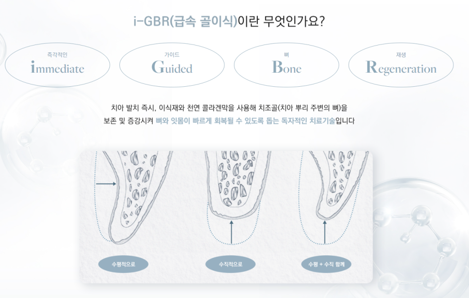 임플란트수술 단순히 심는 줄로만 알았다면 확인해 봐야 할 (임플란트수술) 관련 이미지 2