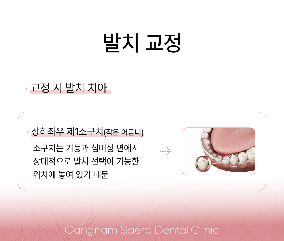 비발치 교정이 다 좋지만은 않은 이유 (발치교정 이유) 관련 이미지 3