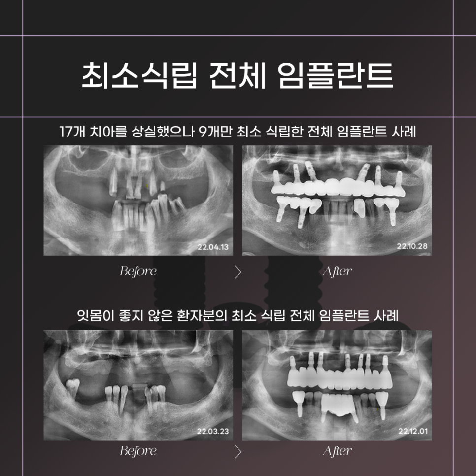 전체임플란트 건강보험적용 (65세이상임플란트) 관련 이미지 3