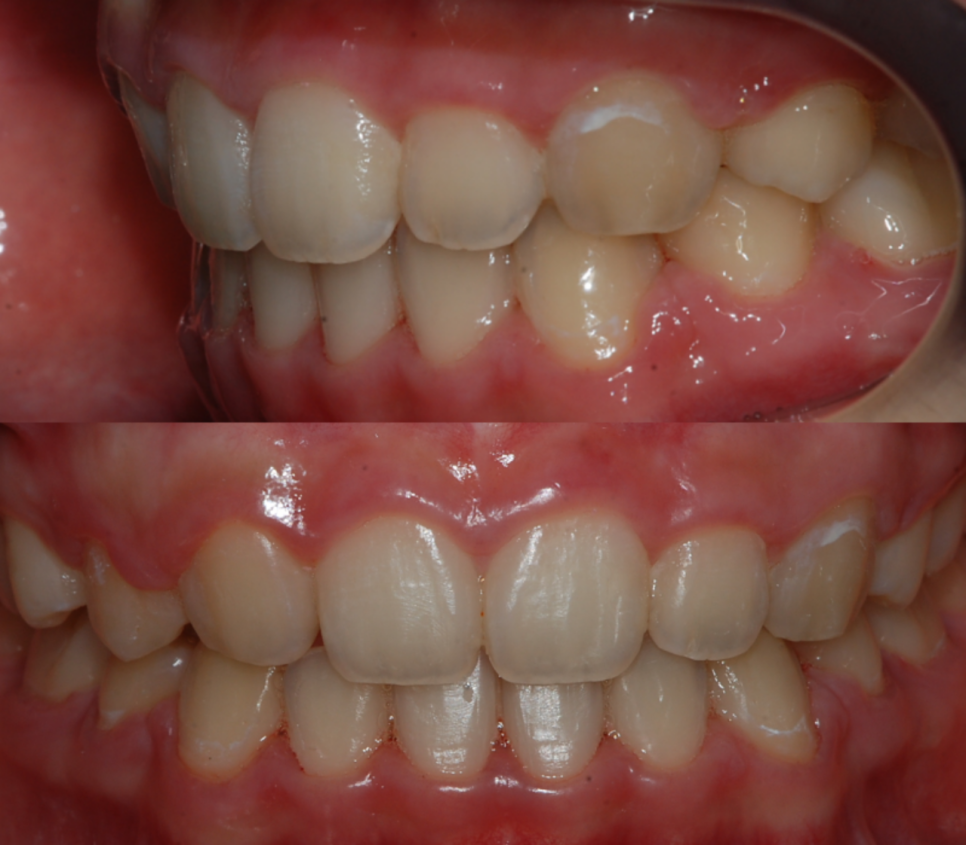 콤플렉스인 뻐드렁니 돌출입 교정으로 개선이 가능할까? 관련 이미지 6