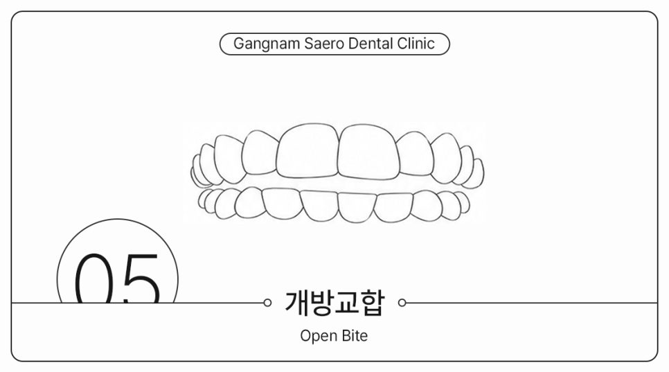 부정교합 개방교합 과개교합 투명교정으로 가능할까요? (주걱턱교정기 돌출입교정기) 관련 이미지 8