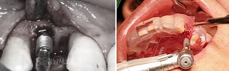 강남네비게이션임플란트 장점 관련 이미지 6