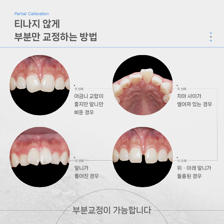 LPA MTA 부분교정 (앞니만 교정하고 싶을 땐 전체교정 대신 부분교정) [ 강남새로치과 ] 관련 이미지 2