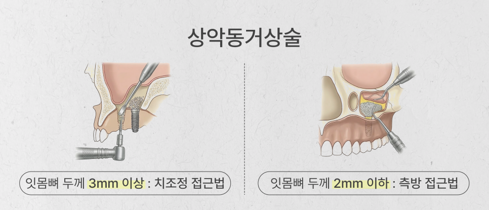 어머니 아버지를 위한 전체임플란트 최소 식립 (65세이상임플란트) 관련 이미지 2