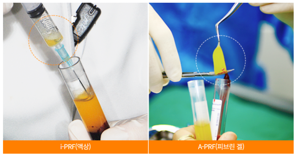 당뇨, 고혈압, 골다공증 환자 맞춤형 (PRF임플란트 자가혈임플란트) 관련 이미지 4