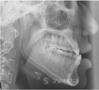 양악전 교정과 양악후 교정, 진행 방법의 차이를 알아보자. 관련 이미지 5
