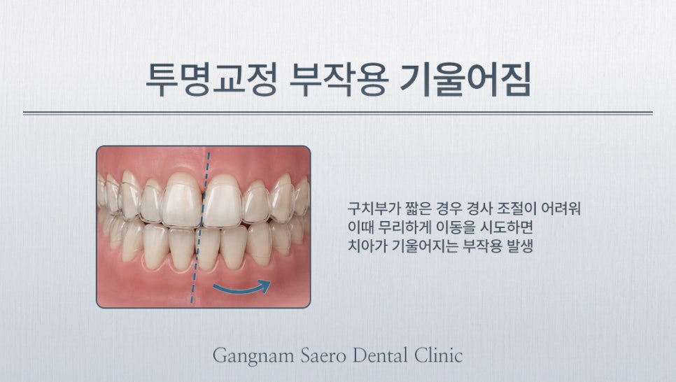 투명교정 시작 전 꼭 알아야 할 한계와 보완 방법 (투명교정부작용) 관련 이미지 3
