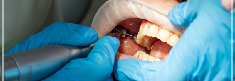 강남역충치치료 원인에 맞는 대처로 관련 이미지 6