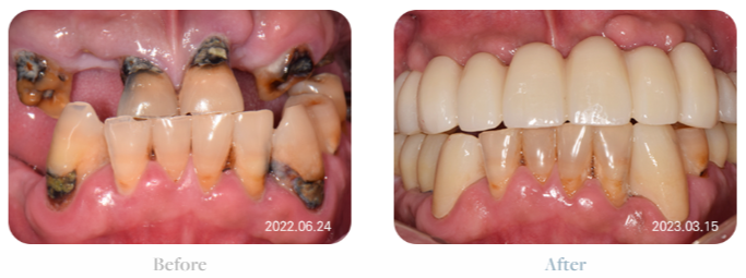 치아가 얼마 안 남은 65세이상임플란트 (전체임플란트후기) 관련 이미지 3