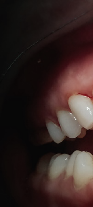 치은염 증상 어떠한 문제들이 있을까요? 관련 이미지 8