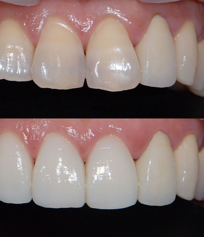 헨리라미네이트, 보다 안전한 진행 과정의 에어네이트로 관련 이미지 5