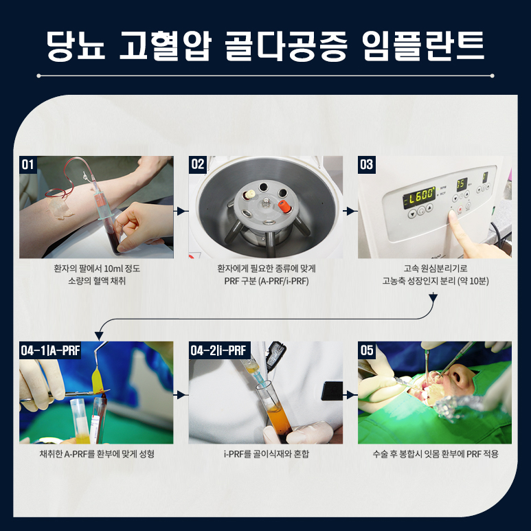 임플란트에 공경심을 담아봅니다 (건강보험임플란트) 관련 이미지 5