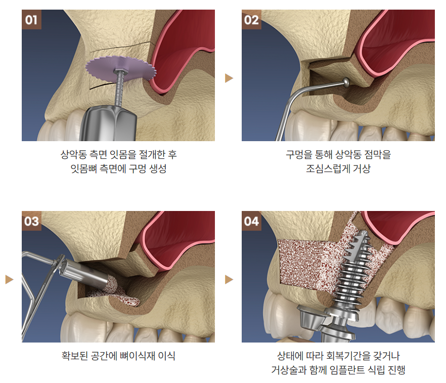 임플란트 안전한 결과를 위하여 [ 상악동거상술 ] [ 강남새로치과 ] 관련 이미지 6