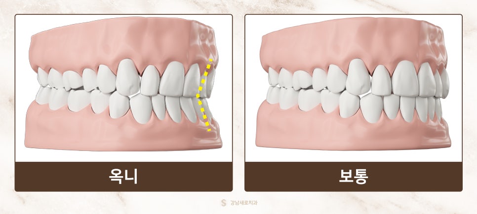 교정 부작용 총정리 [ 교정 부작용 예방법 ] [ 강남새로치과 ] 관련 이미지 3