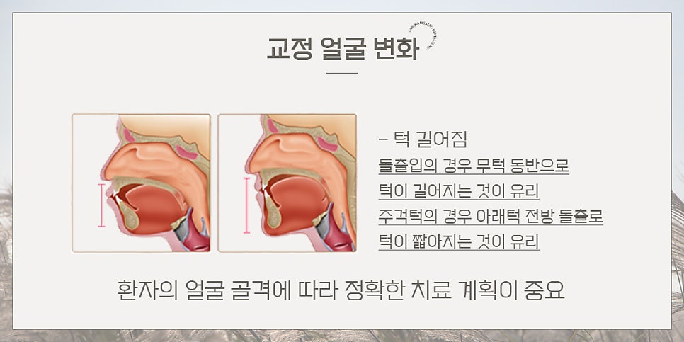 연예인 교정 후 얼굴 변화? (교정얼굴변화) 관련 이미지 4